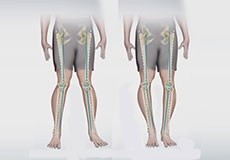 Knee Angular Deformities