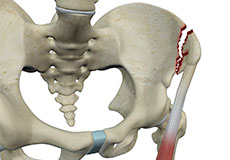 Avulsion Fractures of the Pelvis