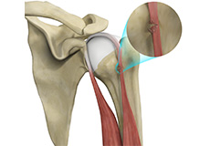 Bicep Tendon Rupture at Shoulder