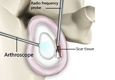 Arthroscopic Capsular Release