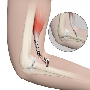 Distal Biceps Tendon Repair