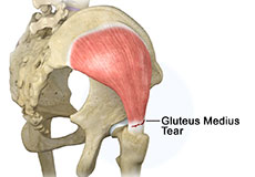 Gluteus Tendon Tear