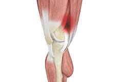 Iliotibial Band Syndrome