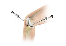 Knee Arthroscopy