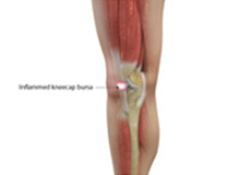 Kneecap Bursitis