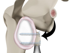 Latarjet Procedure