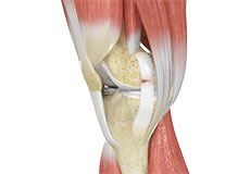 Knee Ligament Injuries