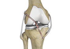 Multiligament Knee Reconstruction