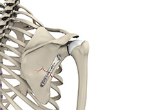 ORIF of the Scapula Fractures