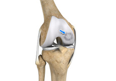 Osteochondritis Dissecans of the Knee