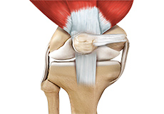 Quadriceps Tendon Repair