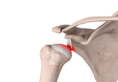 Arthroscopic Shoulder Stabilization