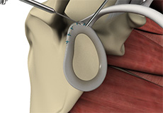 Arthroscopic SLAP Repair