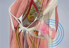 Snapping Hip Syndrome