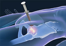 Stem Cell Therapy for Hip Injuries