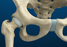 Stress Fractures of the Hip