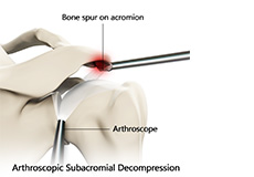 Arthroscopic Subacromial Decompression