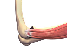 Tennis Elbow Surgery