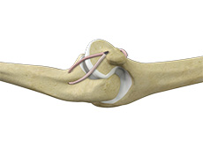 Ulnar Collateral Ligament (UCL) Reconstruction